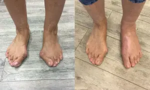 Vorher-Nachher-Vergleich von Füßen mit Hallux valgus, rechts nach Lapidus Arthrodese.