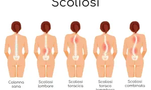 Illustrazione mostra diverse forme di scoliosi, inclusa la scoliosi lombare e toracica, evidenziando il gibbo.