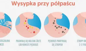 Półpasiec objawy u dziecka: Jak rozpoznać i uniknąć powikłań