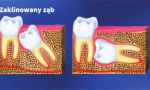 Objawy zęba mądrości: jak rozpoznać ból, stany zapalne i kiedy iść do dentysty