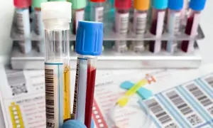 Cholesterol czy na czczo? Co musisz wiedzieć przed badaniem krwi