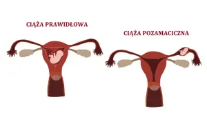 Ciąża pozamaciczna a test ciążowy - co musisz wiedzieć?
