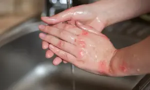 Pękająca skóra dłoni z ranami, które są myte pod bieżącą wodą.