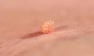 Broczawka, jeden z objawów HPV, widoczna na skórze.