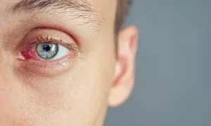 Zatarte oko, zaczerwienione i podrażnione, z widocznymi naczynkami.
