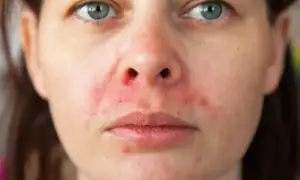 Twarz kobiety z zaczerwienioną, podrażnioną skórą wokół nosa i ust. Wygląda na to, że to objawy uczulenia.