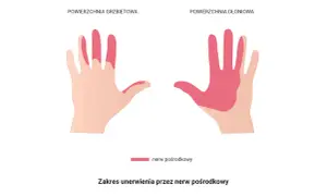 Obszar unerwienia przez nerw pośrodkowy na grzbietowej i dłoniowej stronie dłoni. Może to być związane z drganiem mięśni.