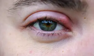 Widoczny jęczmień na oku, zaczerwienienie powieki sugeruje brak witaminy.