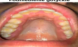 Widok jamy ustnej z zębami i podniebieniem. Charakterystyczne, wysokie podniebienie gotyckie.