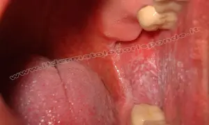 Lesione reticolare bianca sulla mucosa orale, tipica del lichen planus.