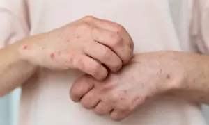 Manos con erupciones rojas y picazón, indicativo de piel atópica.