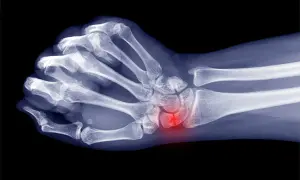 Röntgenbild einer Hand mit hervorgehobenem, entzündetem os triquetrum.
