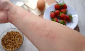 Skóra dziecka z zaczerwienionymi bąblami, objaw alergii pokarmowej. W tle truskawki, jajko i ciecierzyca.