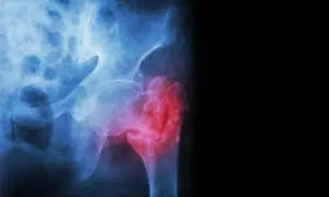 Radiographie du bassin montrant une fracture du col du fémur, marquée en rouge pour indiquer la douleur et la lésion.
