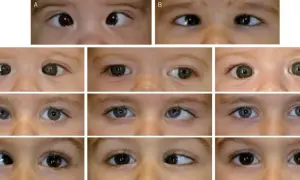 Primeros planos de ojos de bebés y niños pequeños, mostrando diferentes tipos de estrabismo en niños de 1 a 2 años.