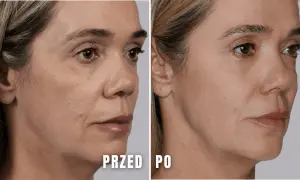 Porównanie skóry kobiety przed i po zabiegu kosmetycznym.