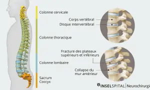 Illustration montrant une fracture vertèbre lombaire. Le temps de guérison dépend de la gravité de la lésion.