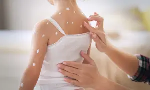 Ospa: Jaki lek na gorączkę? Tego unikaj! Co podać dziecku?