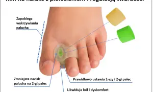 Haluks: Ból stóp? Jak rozpoznać i skutecznie leczyć paluch koślawy