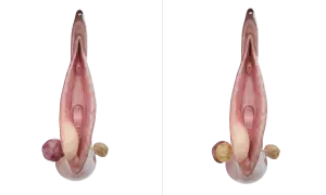 Anatomie féminine montrant une glande de Bartholin enflammée, illustration pour le bartholinite traitement.
