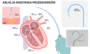 Ilustracja pokazuje, jak ablacja serca co to jest: cewniki wprowadzane do serca, by zlokalizować i zniszczyć źródło arytmii.