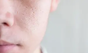 Primo piano della pelle di un uomo, mostrando cosa sono i pori dilatati e cicatrici da acne.