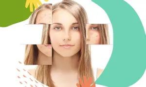 Młoda kobieta z widocznymi zmianami skórnymi, pokazująca jak pozbyć się trądziku.