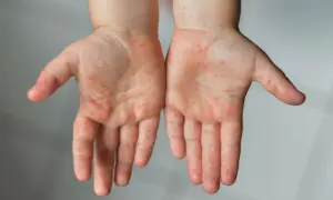 Alergia na lateks objawy - jak rozpoznać niebezpieczne reakcje?