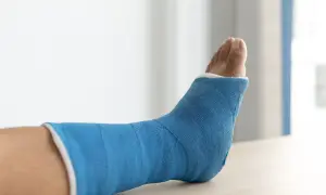 Noga w niebieskim gipsie, widoczne palce stopy.