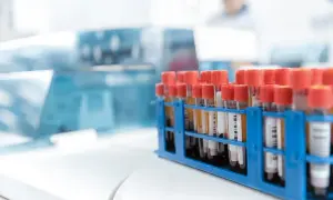 Badania hematologiczne: Co to jest i co mówią o Twoim zdrowiu?