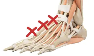 Anatomia del piede con tre croci rosse che indicano il **dolore piede sopra**. Muscoli e tendini evidenziati.