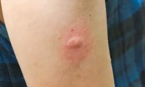 Brazo con una picadura hinchada y dura, rodeada de enrojecimiento.