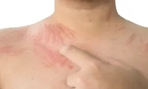 Skóra klatki piersiowej i szyi z czerwonymi pręgami, objaw białego dermografizmu.