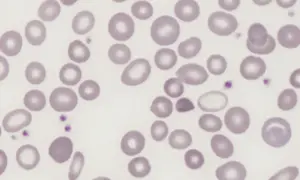 Rozmaz krwi obwodowej z widocznymi różnokształtnymi erytrocytami, sugerującymi rdw-sd powyżej normy.