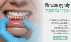 Zaczerwienione, opuchnięte dziąsła i krwawienie to pierwsze sygnały zapalenia dziąseł. Dowiedz się więcej.