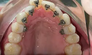 Dettaglio di un apparecchio linguale applicato ai denti superiori, quasi invisibile dall'esterno.