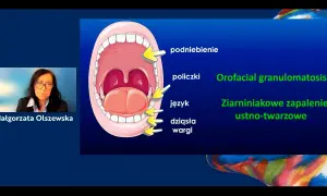 Ilustracja jamy ustnej z zaznaczonymi podniebieniem, policzkami, językiem i dziąsłami. Obok tekst: Orofacial granulomatosis, Ziarniniakowe zapalenie ustno-twarzowe.