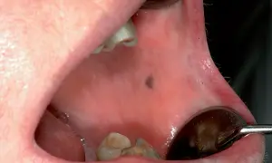 Piccolo neo scuro, una lesione mucosa geniena, visibile all'interno della bocca, vicino ai denti.