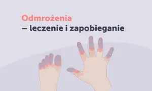 Dłonie i stopy z sinawo-fioletowymi palcami, ilustrujące różne rodzaje odmrożeń.