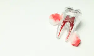 Model zęba z widocznymi kanałami korzeniowymi, otoczony wacikami z krwią, symbolizujący moment, kiedy odpada skrzep po wyrwaniu zęba.