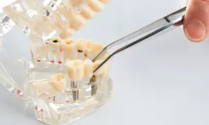 Model szczęki z implantami zębów, gdzie pęseta manipuluje ruszającym się implantem zęba, pokazując jego stabilność.