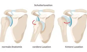 Schulterluxation: normale Anatomie, vordere Luxation (Rotationspfeil) und hintere Luxation (Rotationspfeil). Eine latarjet op kann bei wiederholten Luxationen helfen.