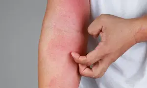 Alergia na leki objawy – jak rozpoznać groźne reakcje alergiczne
