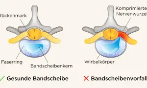 Vergleich einer gesunden Bandscheibe mit einem Bandscheibenvorfall, der eine Nervenwurzel komprimiert und so Symptome verursacht.