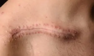 Cicatrice chirurgicale avec des points rouges, comme un fil résorbable qui ne se résorbe pas, sur une peau claire.