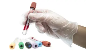Ręka w rękawiczce trzyma probówkę z krwią. W tle kilka innych probówek. Badanie poziomu hemoglobiny glikowanej norma jest kluczowe.