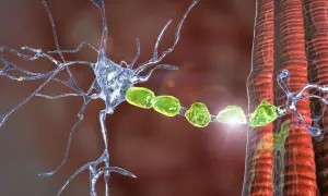 Danno alla mielina neuronale, simile a quello osservato nella Charcot-Marie-Tooth, con fibre nervose e muscolari.