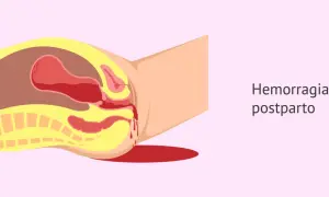 Ilustración anatómica que muestra los tipos de sangrado postparto, con sangre saliendo del útero y la vagina.