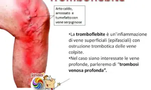 Gamba con arrossamento e vene gonfie, indicativo di un calore improvviso alle gambe.