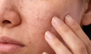 Primo piano del viso con pori dilatati e alcuni punti neri radicati. Dita sfiorano la pelle.